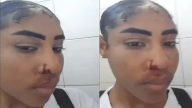 Imagens mostram a estudante com sangramento nasal e hematomas no rosto - Foto: Reprodução/Redes sociais