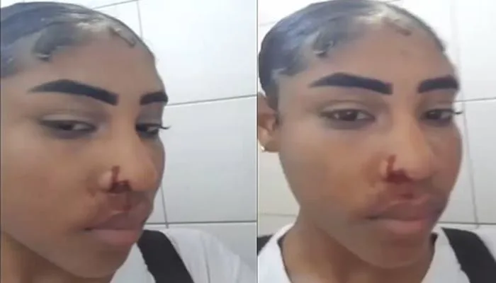 Imagens mostram a estudante com sangramento nasal e hematomas no rosto - Foto: Reprodução/Redes sociais