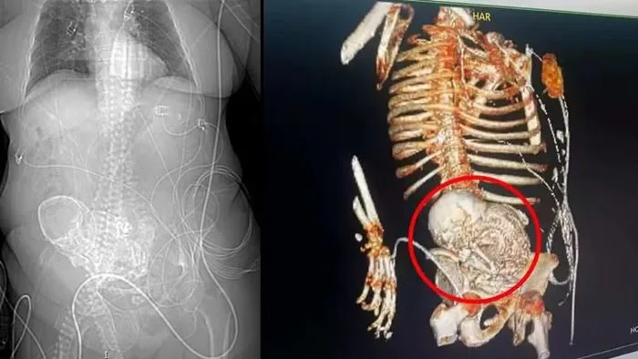 Idosa morreu após descobrir bebê calcificado em abdômen. — Foto: Reprodução