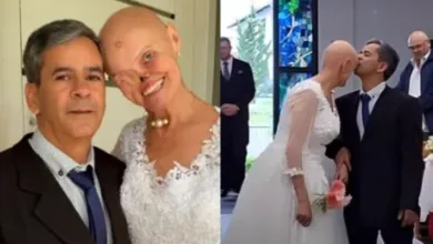 mulher com câncer de pele se casa