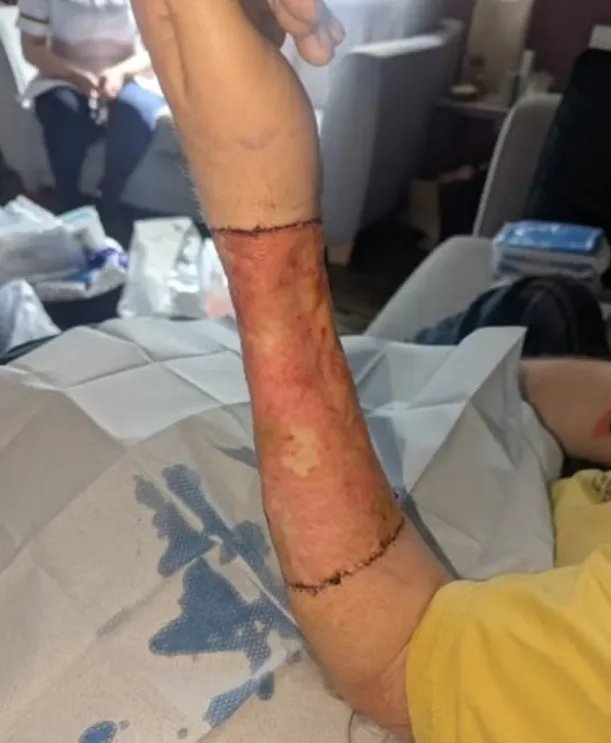 Homem perde pênis para câncer